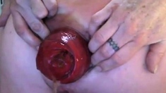 Biggest anal prolapse